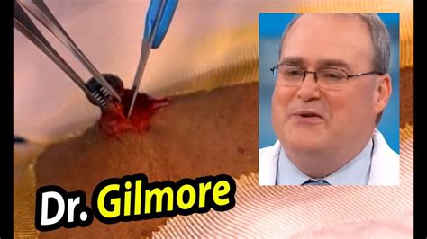 dr john gilmore youtube|worst cysts that explodes.